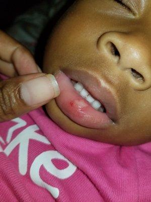 2 separate occasions, my daughter lip gets busted and no one knows how. The 1st time I was told she bit her lip herself.Or she came they way