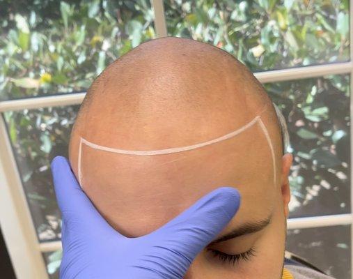 Scalp Micropigmentation - Before