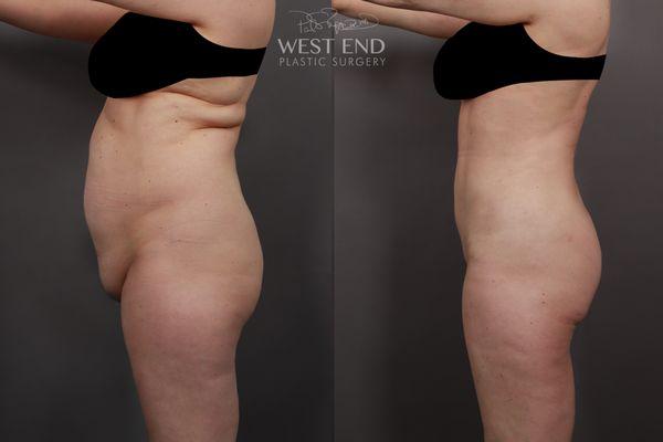 Dr. Ruff performed a Mons Pubis Lift, Liposuction & Renuvion Skin Tightening.