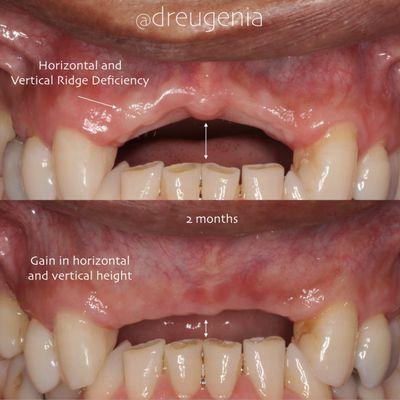 Building bone in a deficient ridge for implant placement in the anterior