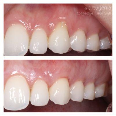 Connective Tissue Graft to treat root exposure and anesthetic appearance