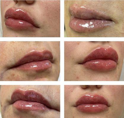 Lip Treatments in Oviedo FL