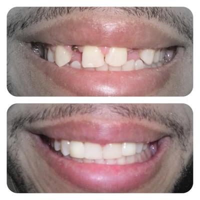 Dental Implant restorations done chairside in just 30 minutes!