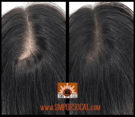 Scalp Micro Pigmentation, a very effective treatment that gives you instant results.