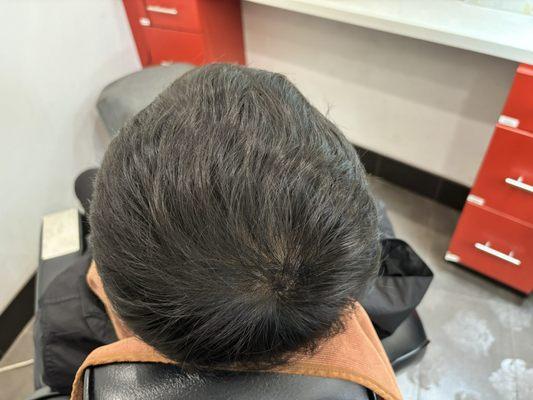 After the Scalp Therapy