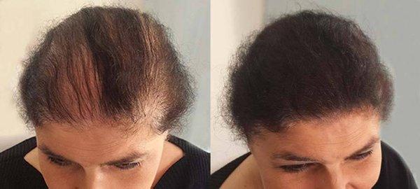 Beforea & After using Hair Loss Prevention Products