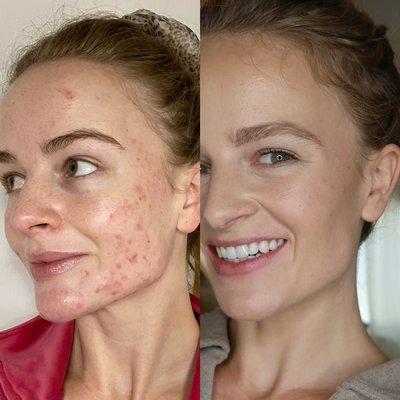 Acne Bootcamp Results