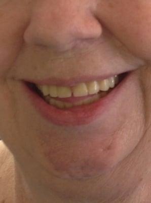 Before picture using Tru Rx Program for full mouth restoration